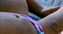 Criança tem queimaduras de segundo grau em creche após sopa cair sobre seu corpo